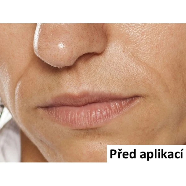 B-Selfie AGELESS - náplast pro vyplnění nosoretních vrásek - 1 ks (2 náplasti)