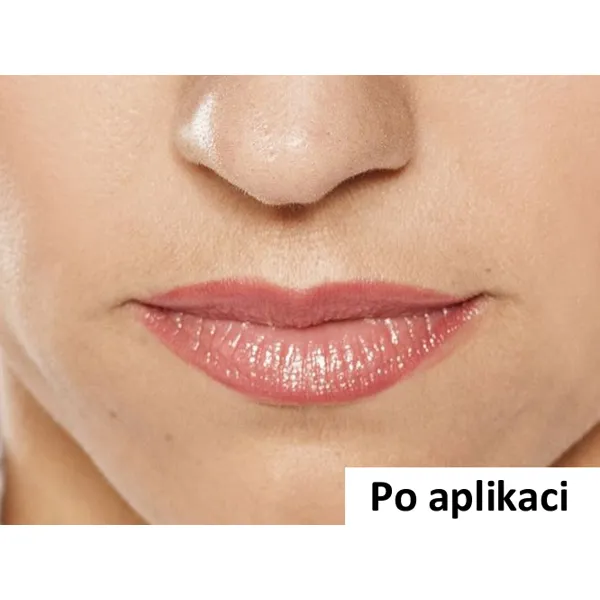 B-Selfie AGELESS - náplast pro vyplnění nosoretních vrásek - 1 ks (2 náplasti)