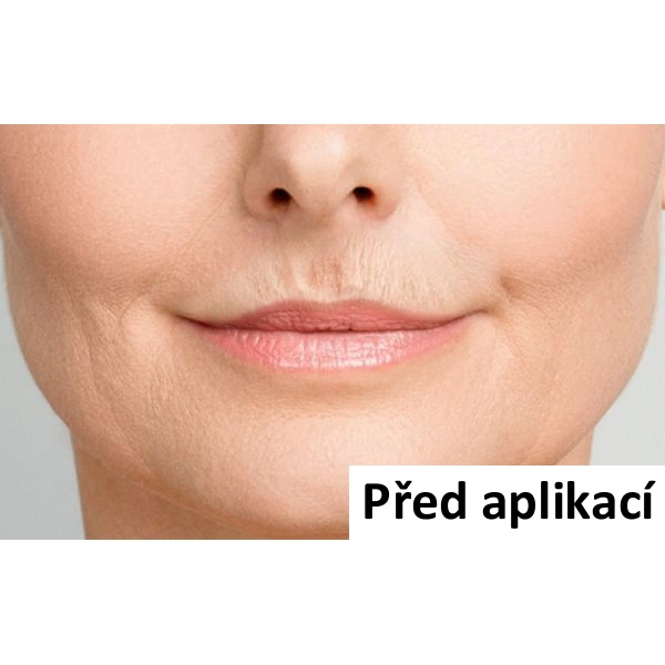 B-Selfie SMOOTH - náplast pro vyplnění tzv.kuřáckých vrásek - 1 ks (2 náplasti)