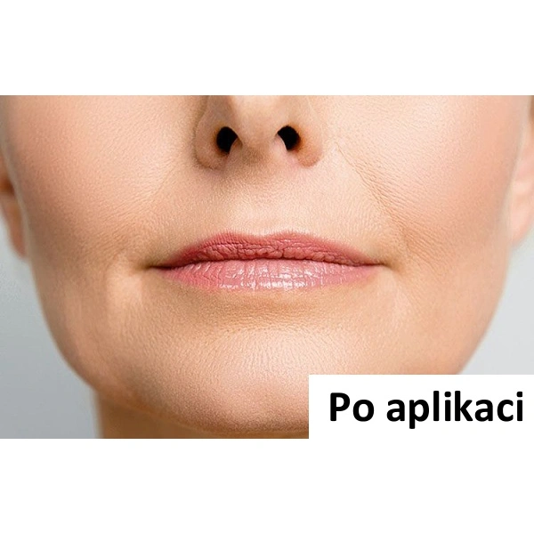 B-Selfie SMOOTH - náplast pro vyplnění tzv.kuřáckých vrásek - 1 ks (2 náplasti)